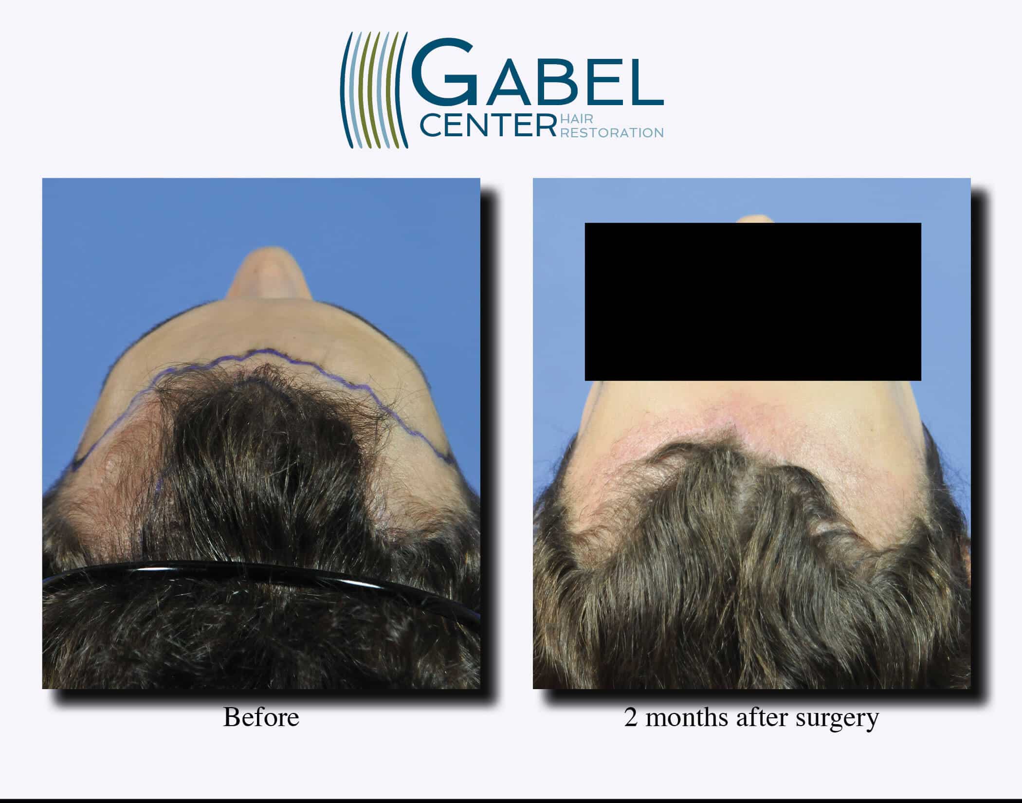 Watch A Patients Real Time Growth After 3439 Grafts Gabel Hair