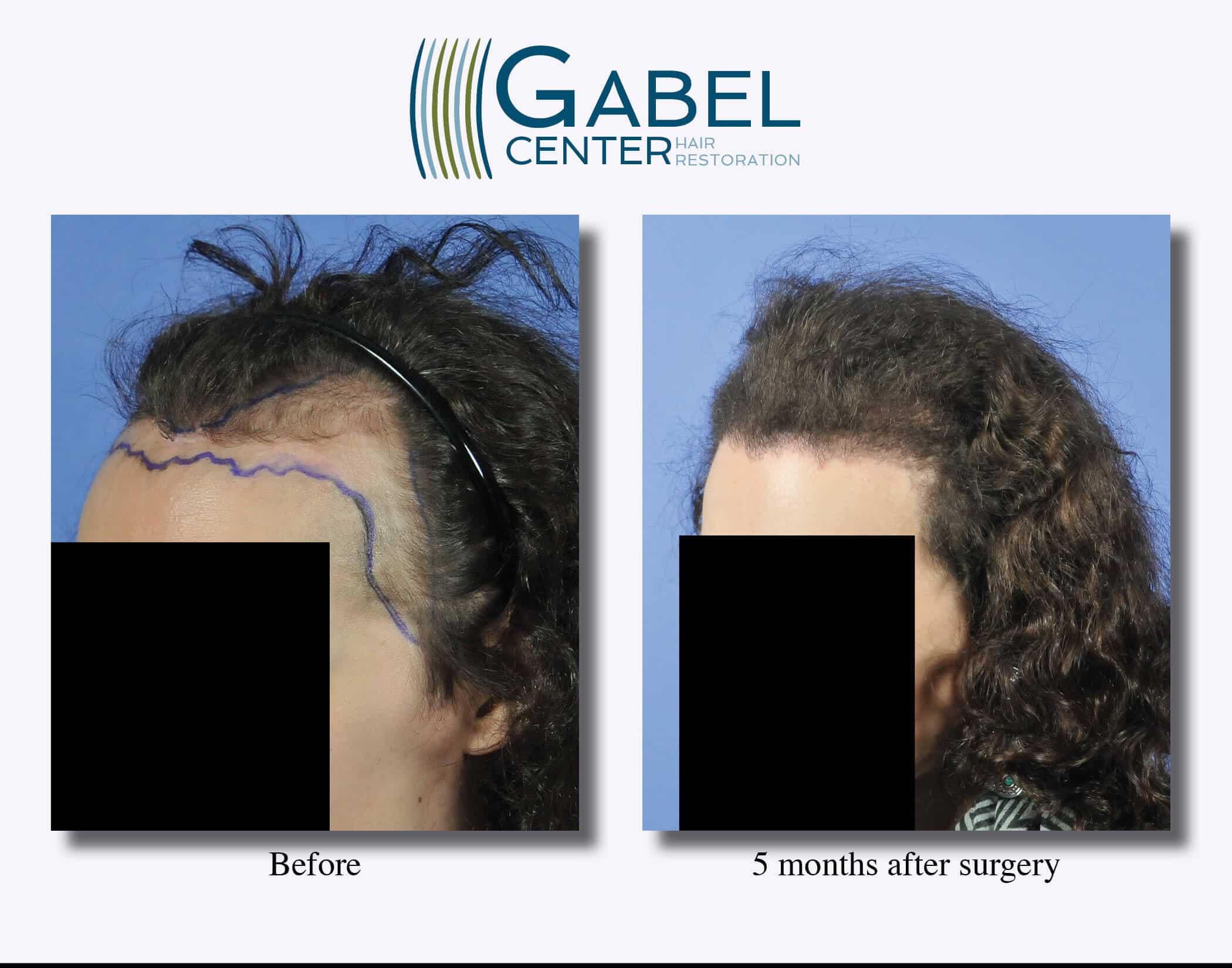 Watch A Patients Real Time Growth After 3439 Grafts Gabel Hair