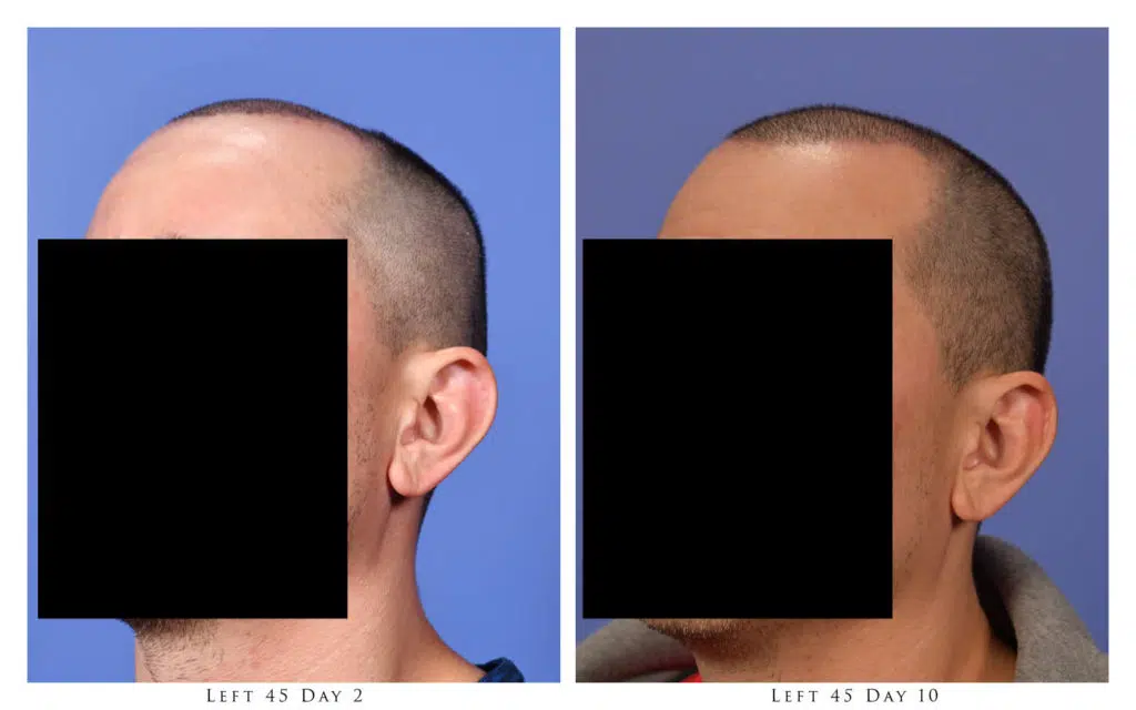 Left Oblique - 2 and 10 Days After Procedure