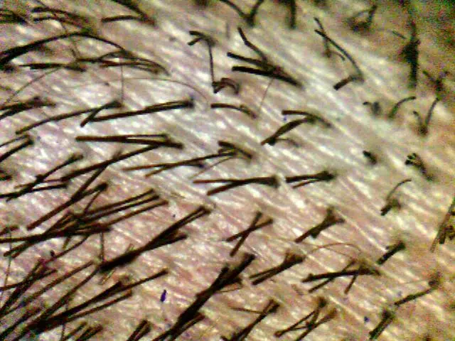 Follicular units exiting the scalp