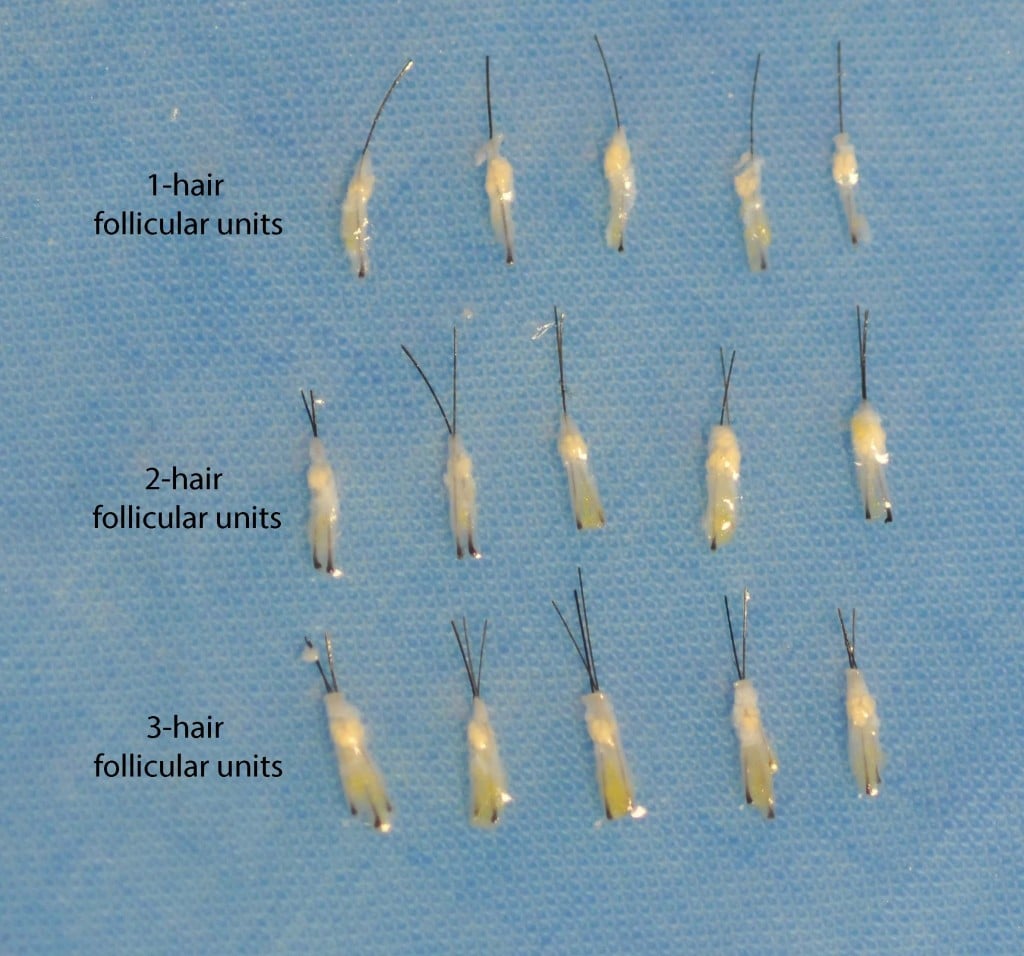 These follicular unit grafts were carefully trimmed and are ready for transplant.