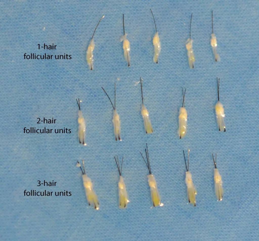These follicular unit grafts were carefully trimmed and are ready for transplant.