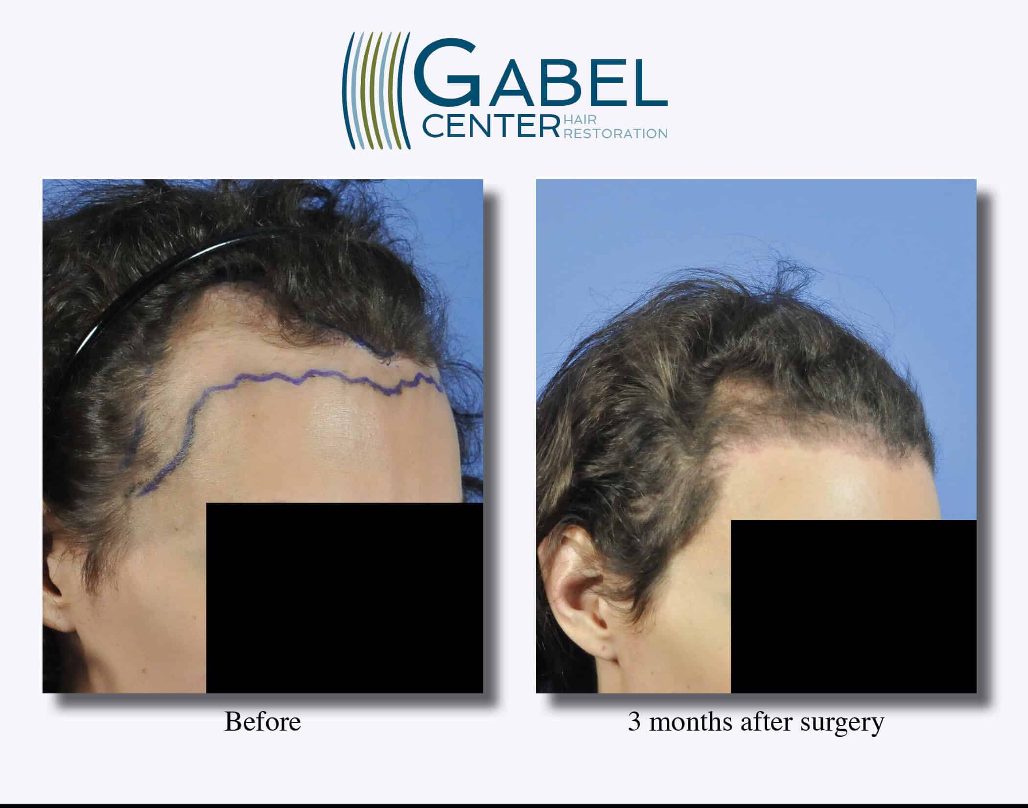 3 month after transplant right view gabel center
