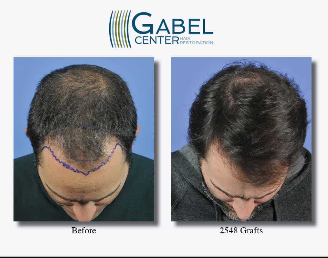 Frontal Hair Transplant Frontal down