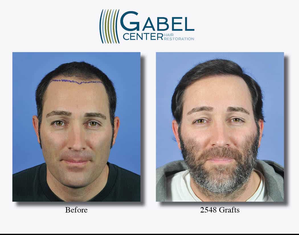 Frontal Hair Transplant of 40-Year-Old Male | Gabel Center
