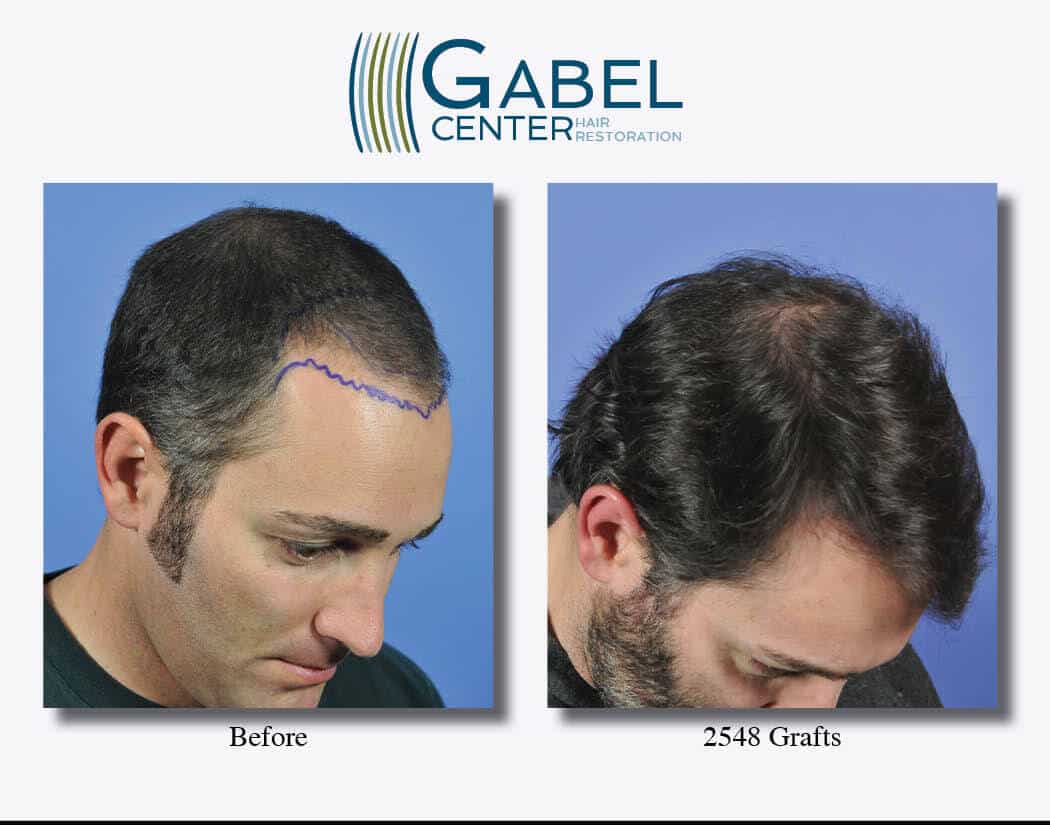 Frontal Hair Transplant right 45 down