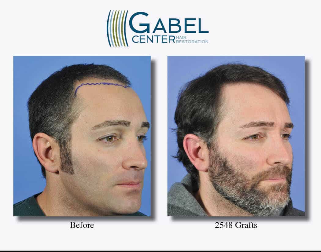 Frontal Hair Transplant right 45