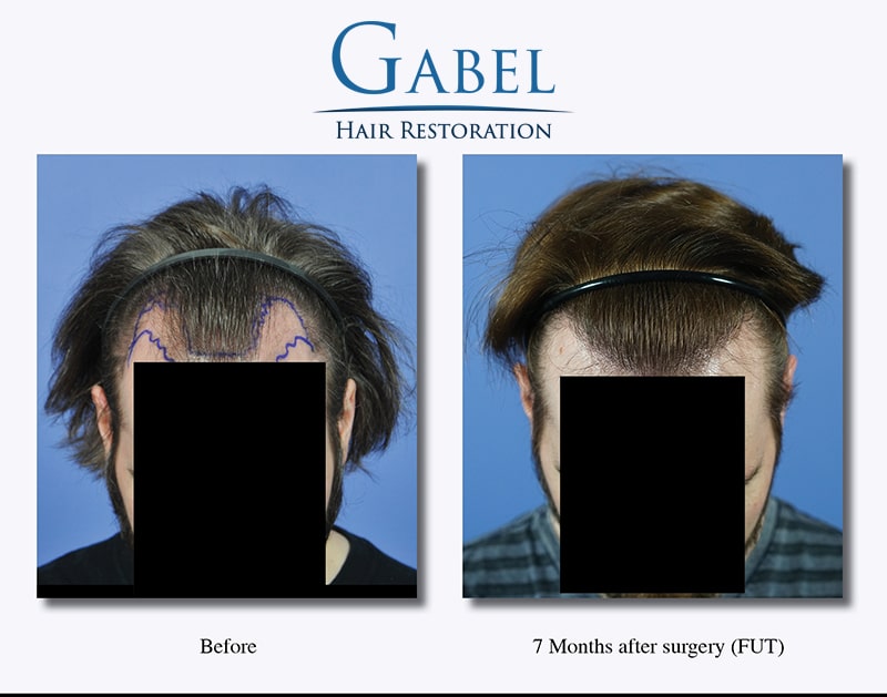 Repairing the deep front-temporal region | Gabel Center Repairing the deep front-temporal region | Gabel Center