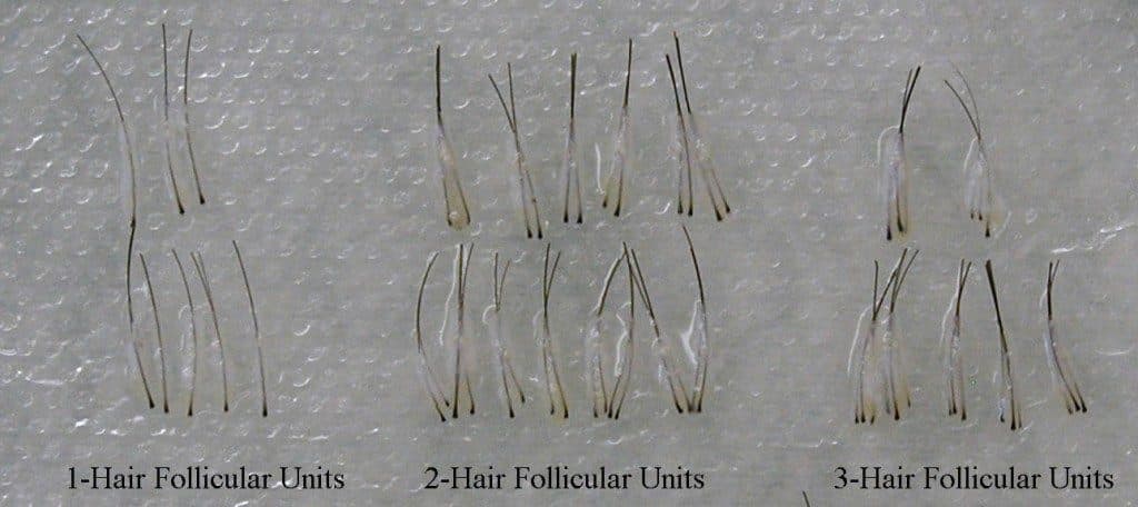 Hair Restoration Techniques in Portland, OR & Seattle, WA Portland Oregon |  Gabel Center