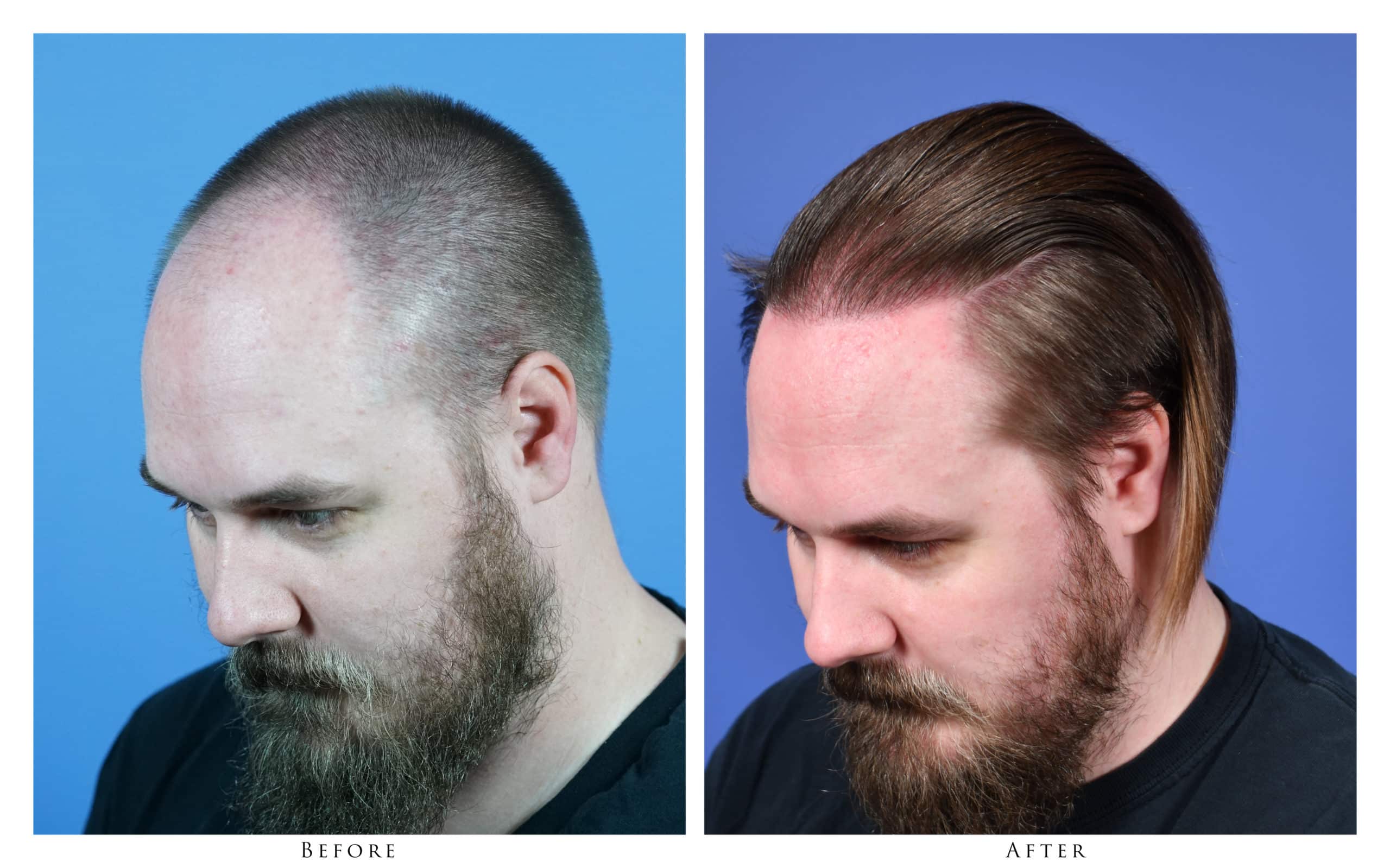 31 yr-Old Male with 2084 Graft FUE Hair Transplant Before ...