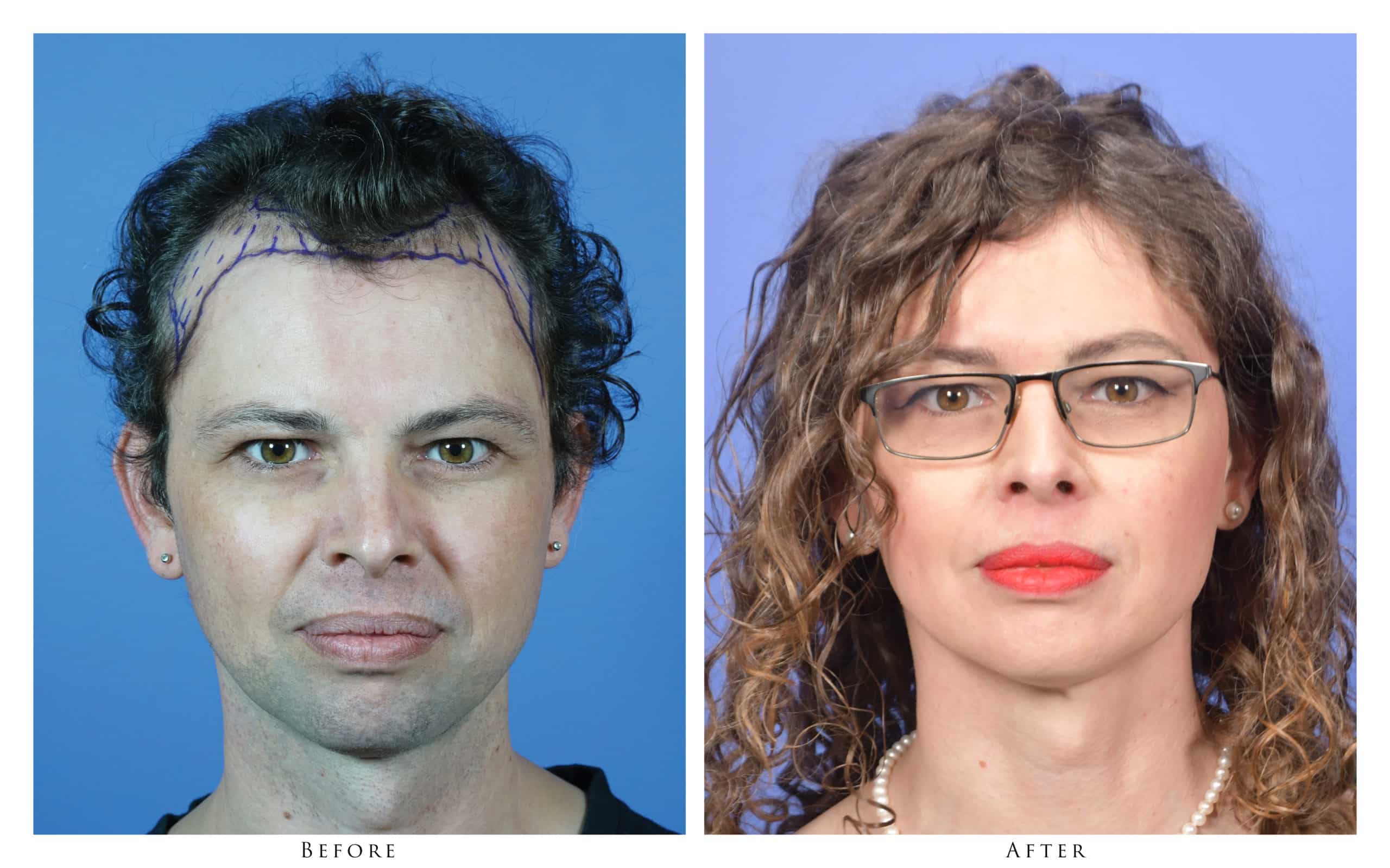 Transgender Before and After Photos Gallery Portland, Oregon