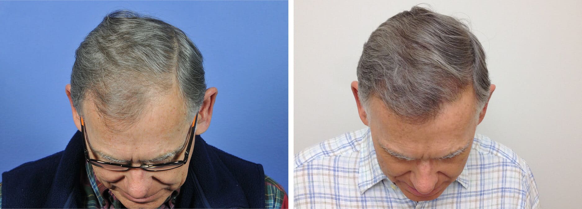 2298 Grafts 60 Yr Old Male Frontal Hair Transplantation Before and After  Photos Gallery Oregon