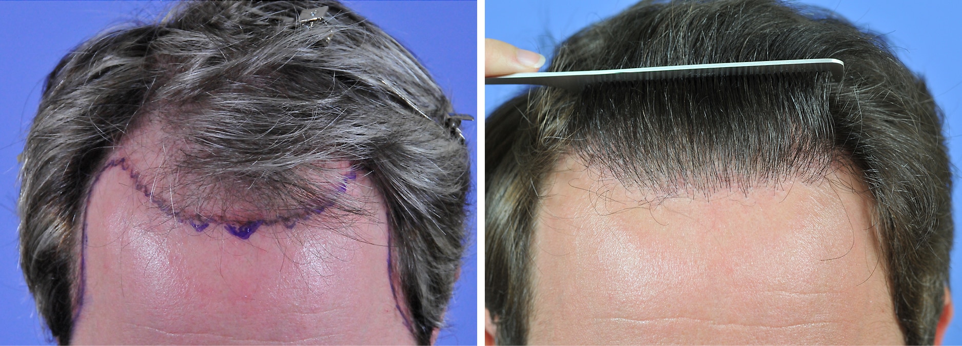 finasteride before and after crown