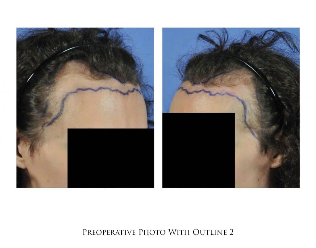Hair Transplant Timeline in Portland, OR & Seattle, WA Portland Oregon | Gabel Center Hair Transplant Timeline in Portland, OR & Seattle, WA Portland Oregon | Gabel Center