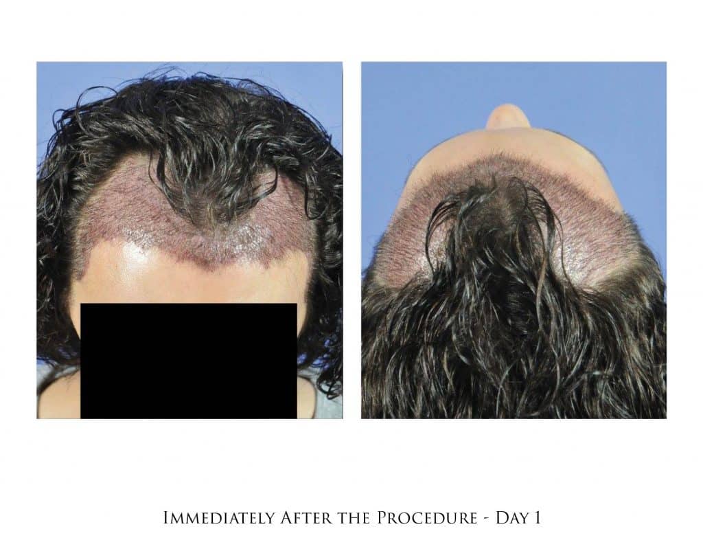 Hair Transplant Timeline in Portland, OR & Seattle, WA Portland Oregon | Gabel Center Hair Transplant Timeline in Portland, OR & Seattle, WA Portland Oregon | Gabel Center