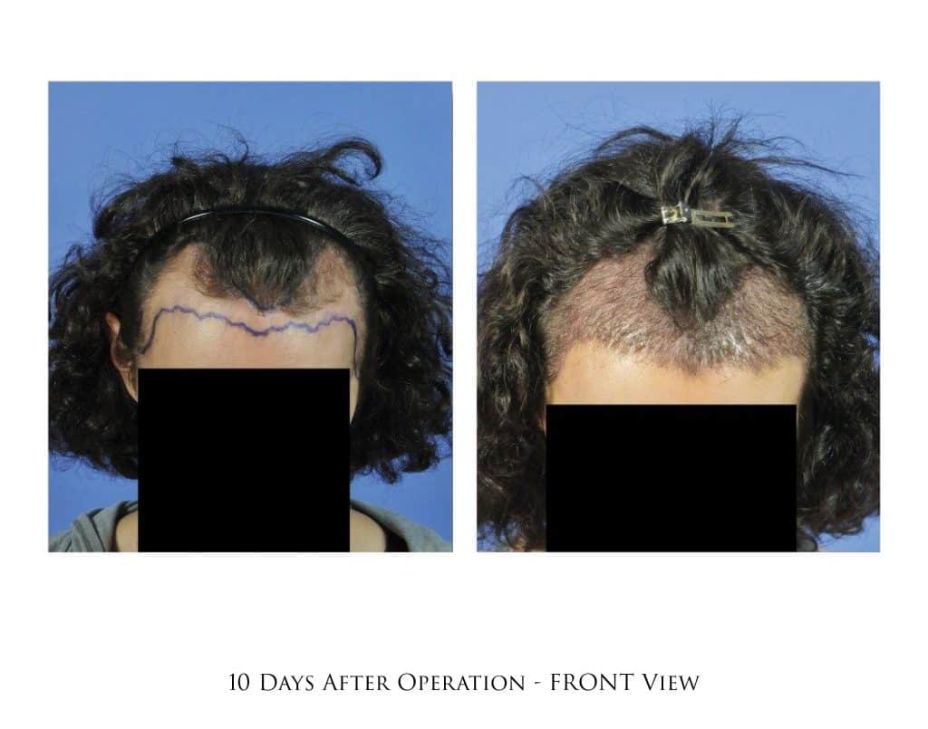Hair Transplant Timeline in Portland, OR & Seattle, WA Portland Oregon | Gabel Center Hair Transplant Timeline in Portland, OR & Seattle, WA Portland Oregon | Gabel Center