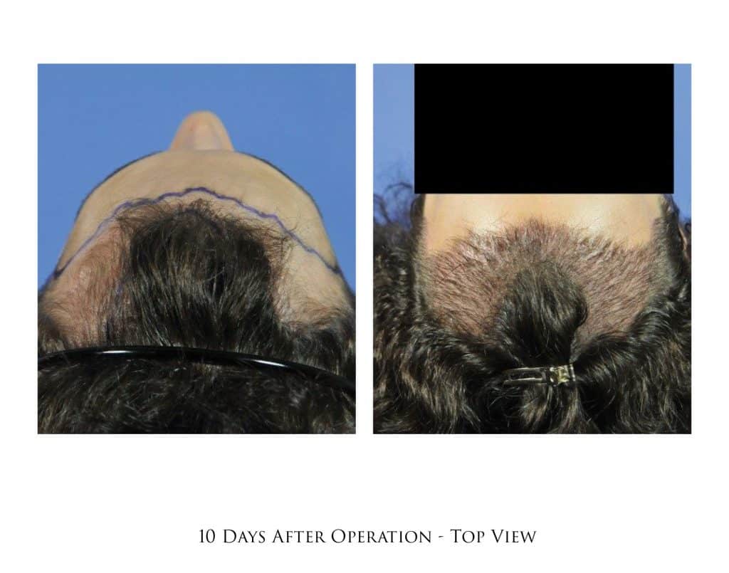 Hair Transplant Timeline in Portland, OR & Seattle, WA Portland Oregon | Gabel Center Hair Transplant Timeline in Portland, OR & Seattle, WA Portland Oregon | Gabel Center