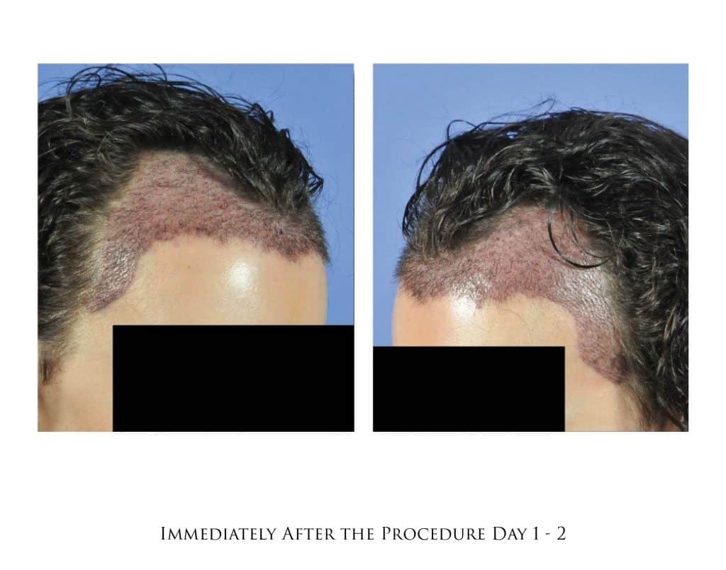 Hair Transplant Timeline in Portland, OR & Seattle, WA Portland Oregon | Gabel Center Hair Transplant Timeline in Portland, OR & Seattle, WA Portland Oregon | Gabel Center