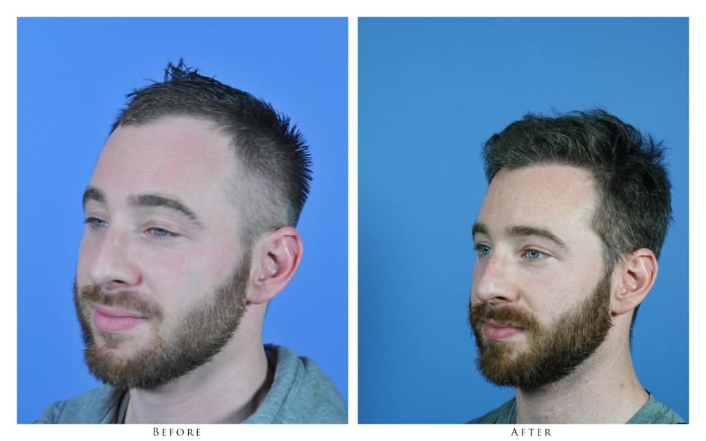 Patient 1737 Results3 FUE Patient of Dr. Gabel