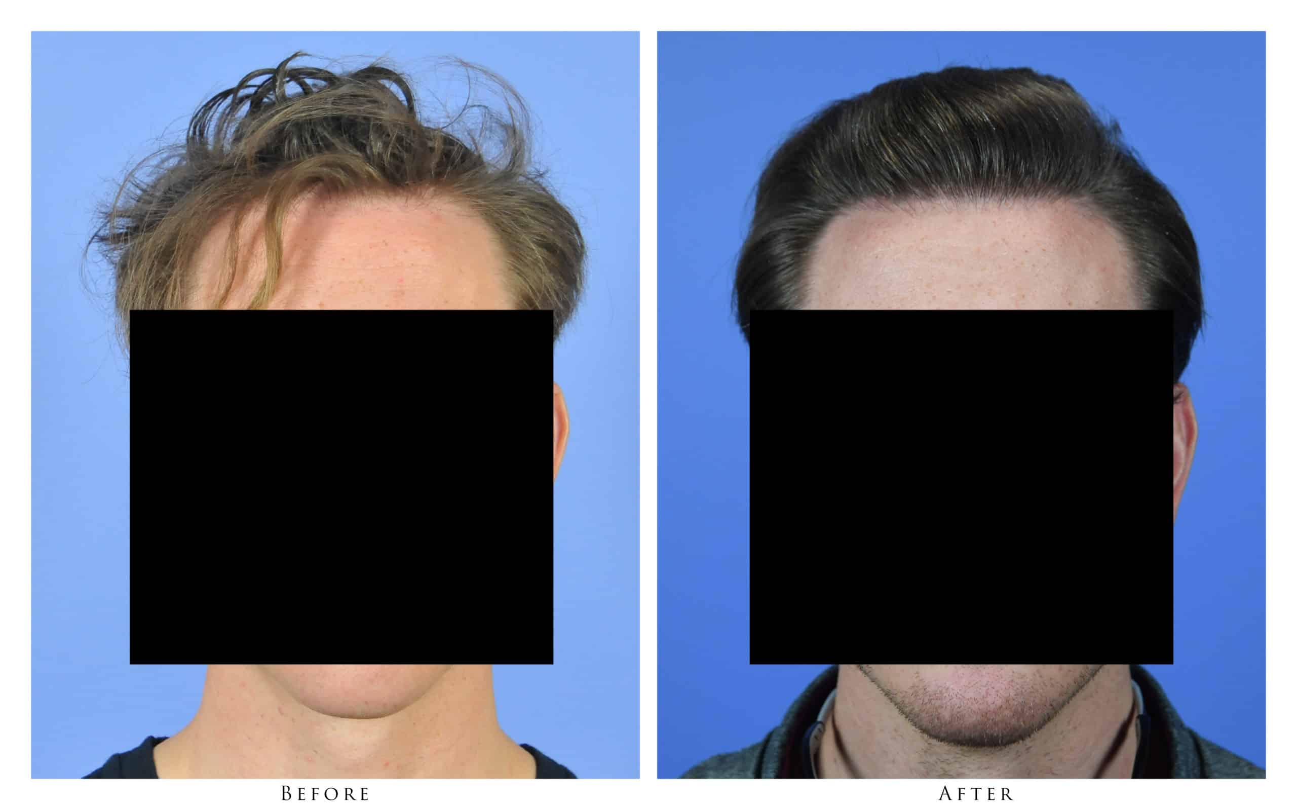 27-year-old male has 1591 graft hair transplant Before and After Photos  Gallery Oregon