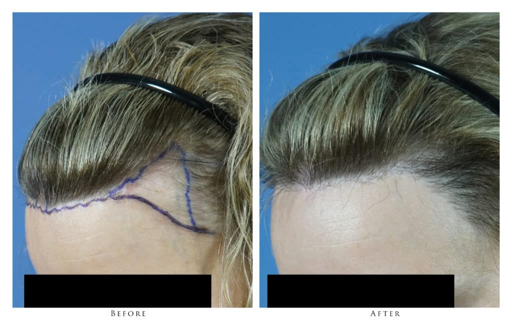 Before and After of the left side of the hairline Close up of the frontal hairline, left side