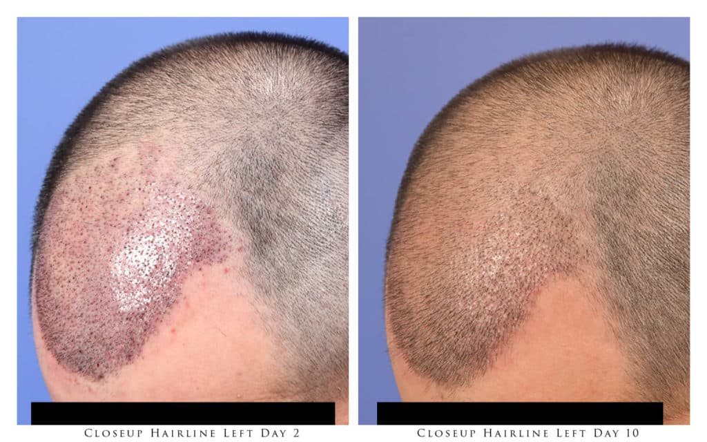 Close-up of Hairline - 2 and 10 Days After Procedure