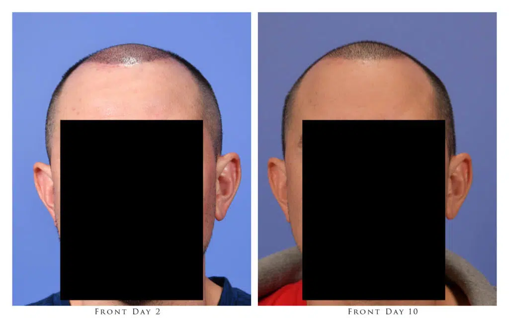 Front View - 2 and 10 Days After Procedure
