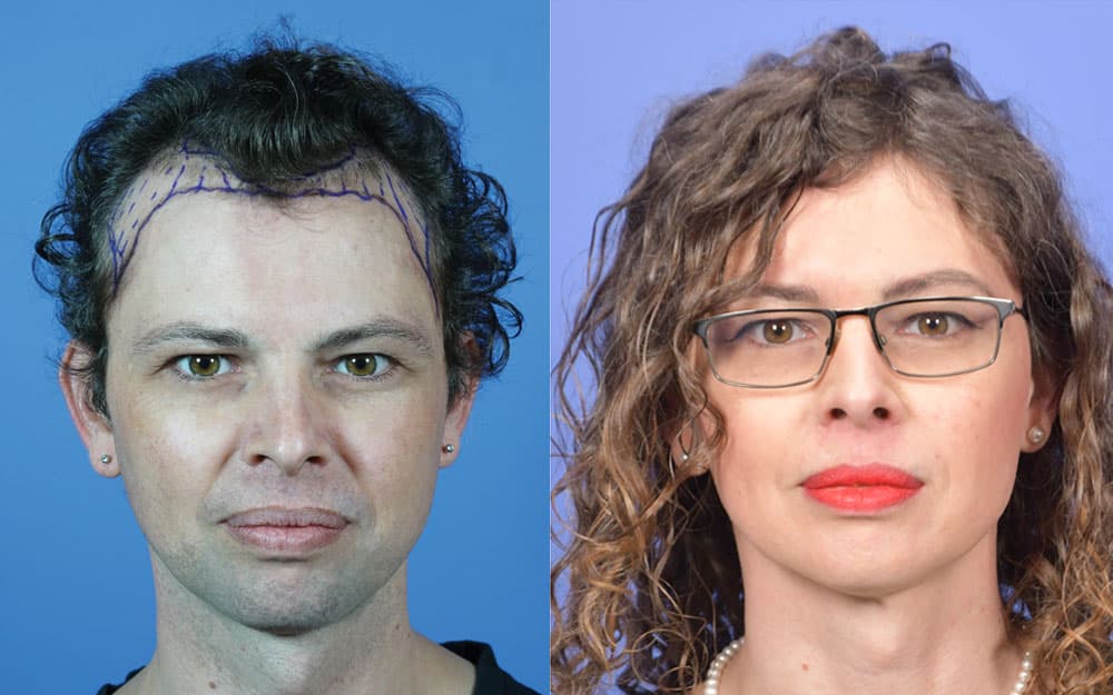 Gabel Hair Restoration Portland OR - Hair Transplants Seattle WA Gabel Hair Restoration Portland OR - Hair Transplants Seattle WA