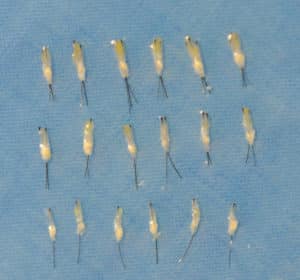 Follicular Unit Grafts Follicular Unit Grafts